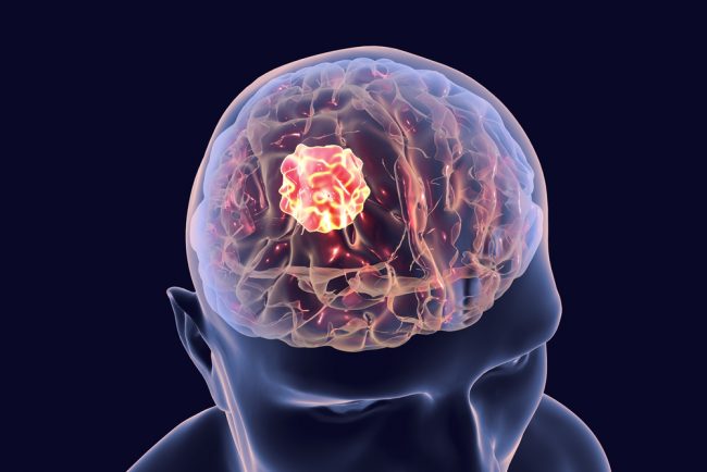 Pandemi Beyin Sağlığını tehdit ediyor! Beyin tümörünün 10 önemli belirtisi!